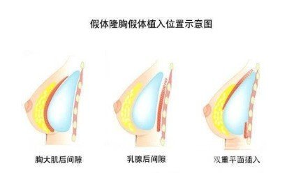 最新的丰胸技术是什么,探索当下最前沿的丰乳塑形技艺。