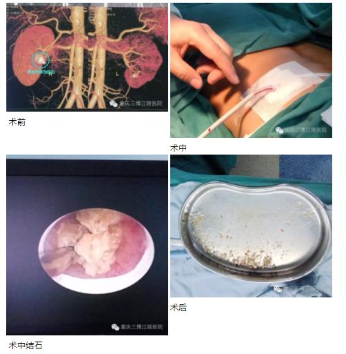 肾结石最新治疗方式,肾结石新疗法解析